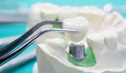 歯周組織の再生や、難しいケースでもインプラント治療が可能