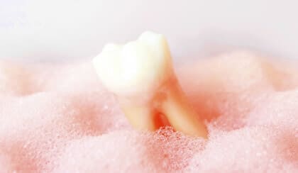 重度の虫歯でも、できる限り神経と歯を抜かない治療