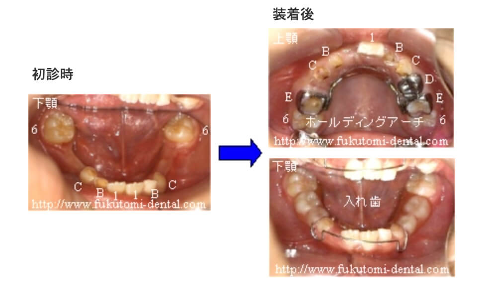 ホールディングアーチ(固定式)と入れ歯による保隙