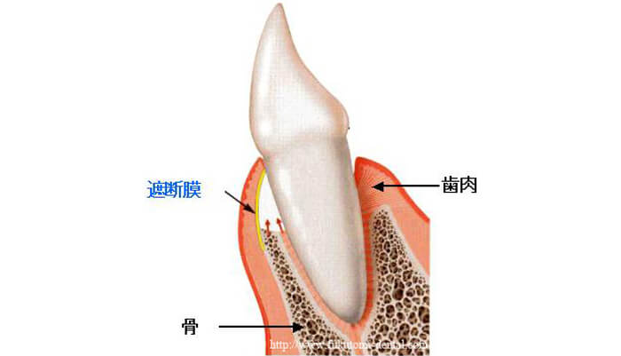 歯周組織再生誘導法