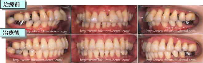 重度歯周病治療の症例