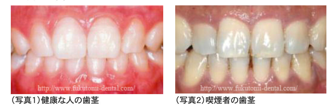 重度歯周病治療の症例